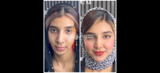 محتاجین مودیلات للفلر و البوتوکس المجانی